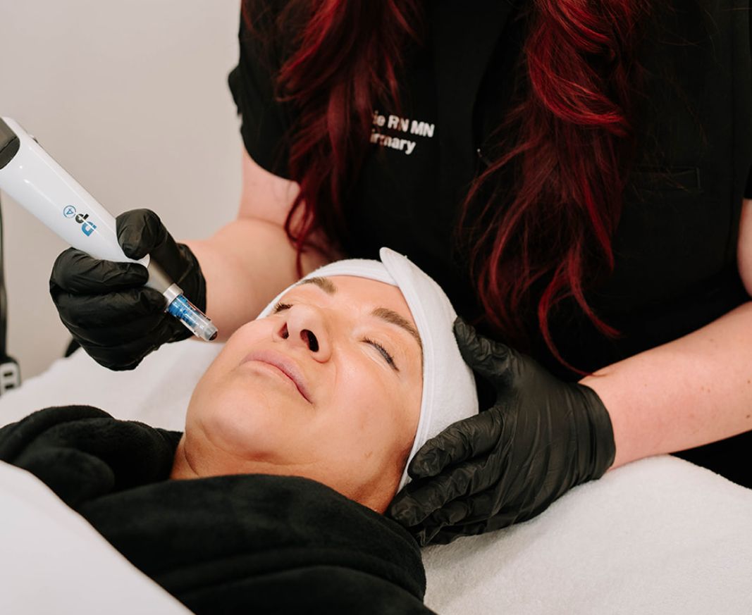 MICRO NEEDLING BLURB